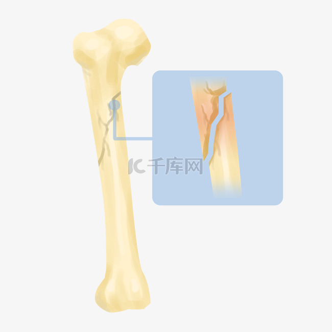 骨头骨折骨裂