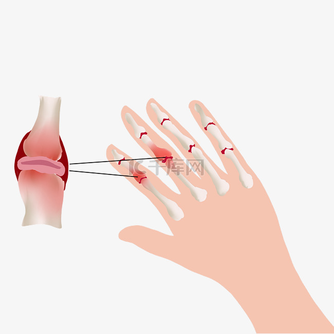 手指关节炎发炎红肿