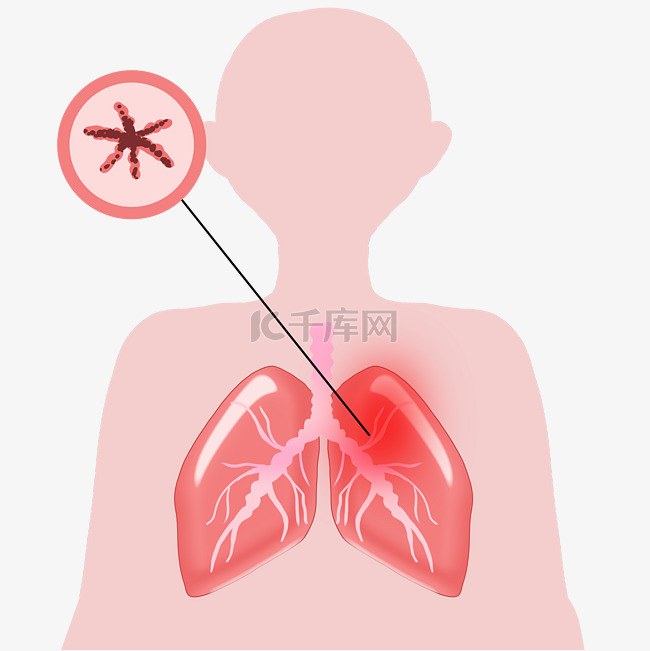 慢阻隔肺气肿