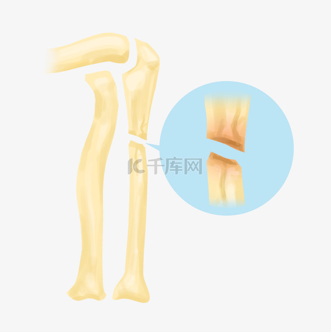 人体骨骼骨折