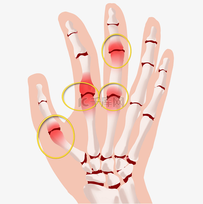 关节炎发炎红肿手指