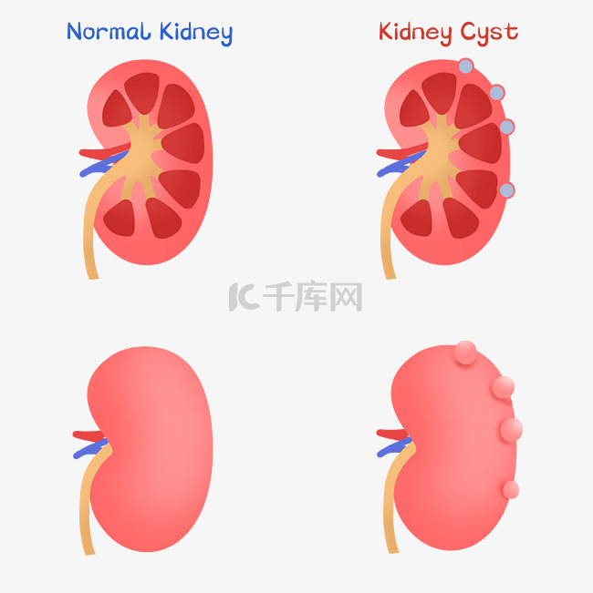 肾癌生病肾脏