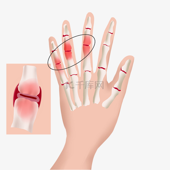 手指关节炎发炎肿痛