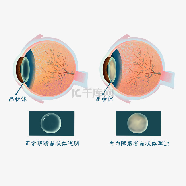 白内障爱眼眼病眼科眼睛疾病医疗