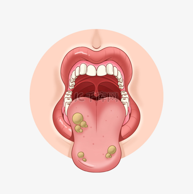 口腔溃疡医学粘膜炎症