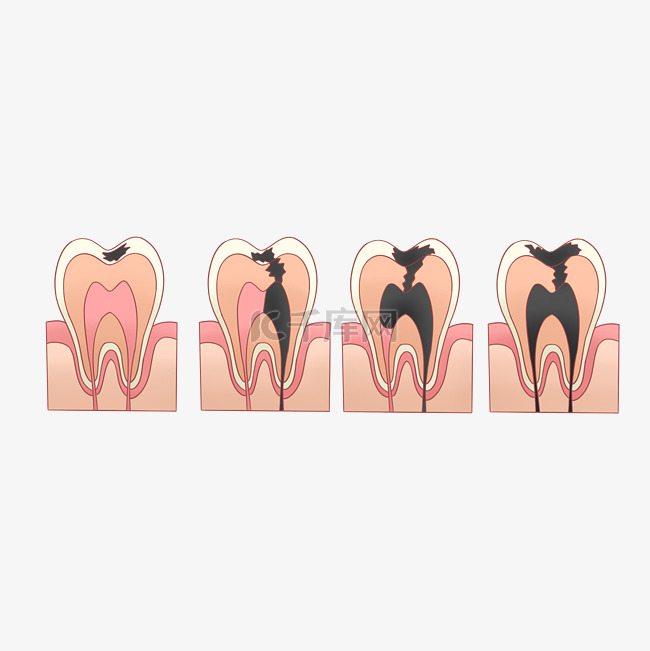 牙科蛀牙形成过程