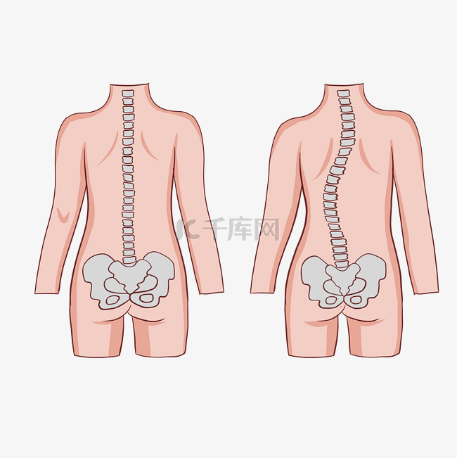 脊柱侧弯矫正健身
