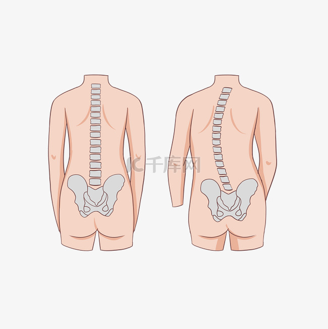 脊柱侧弯矫正