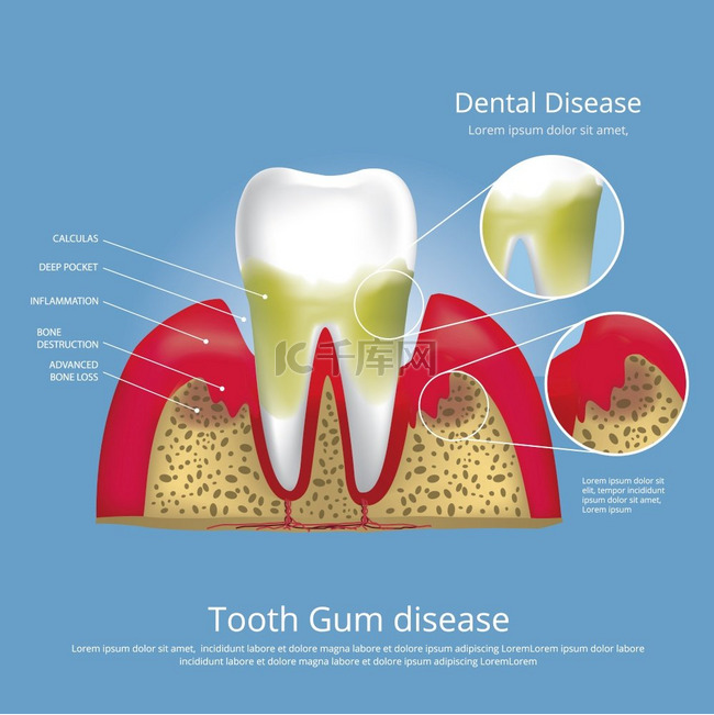 人类牙齿阶段的牙龈疾病媒介图解