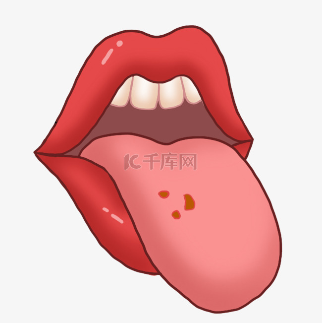 口腔溃疡红色嘴唇舌头溃烂