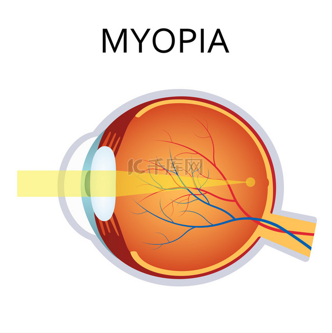 近视。近视是短视.