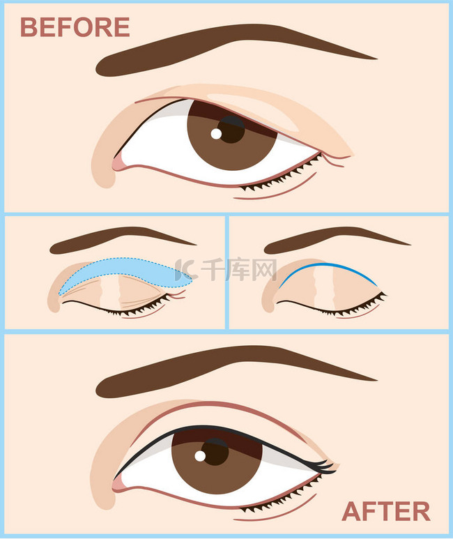 眼睑出血成形术。女性双眼皮手术