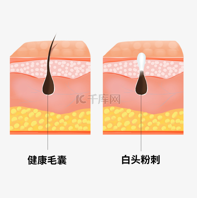 白头粉刺皮肤问题立体剖面图