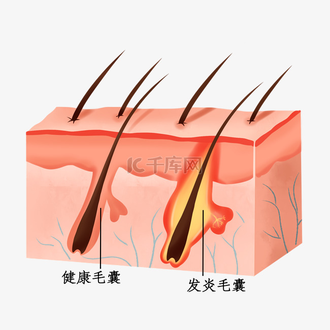 皮肤毛囊问题立体剖面图