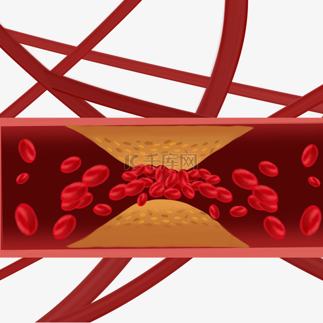 心血管细胞堵塞
