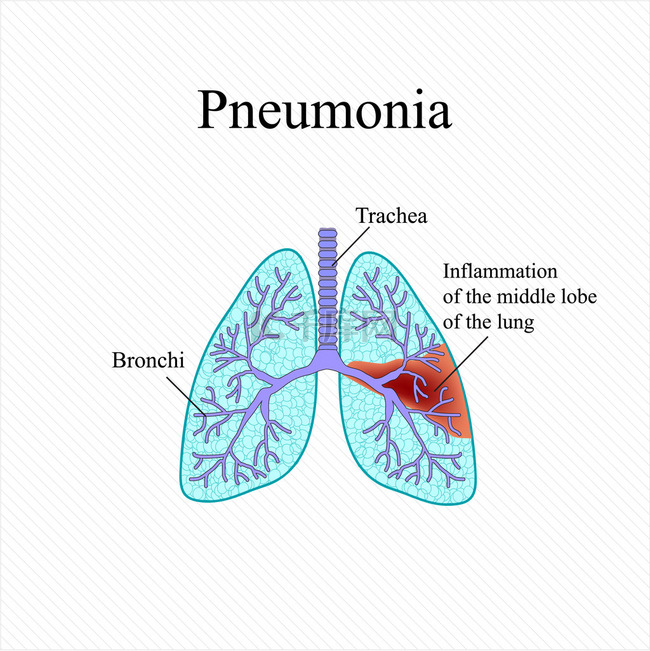 肺炎。人肺的解剖结构。肺中叶的