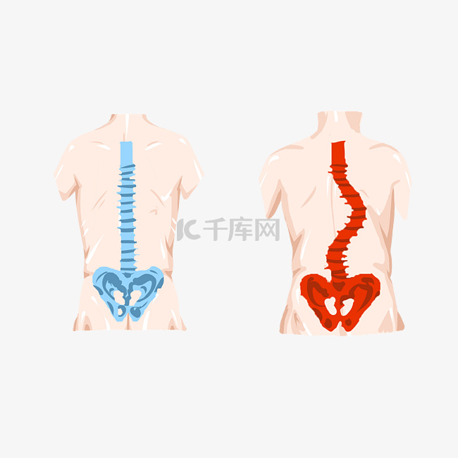 脊柱侧弯矫正健身
