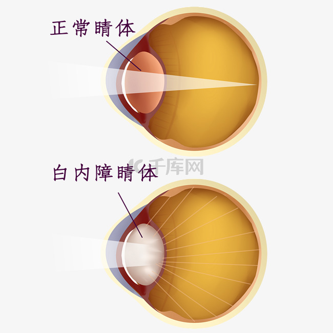 眼科眼睛白内障医疗疾病