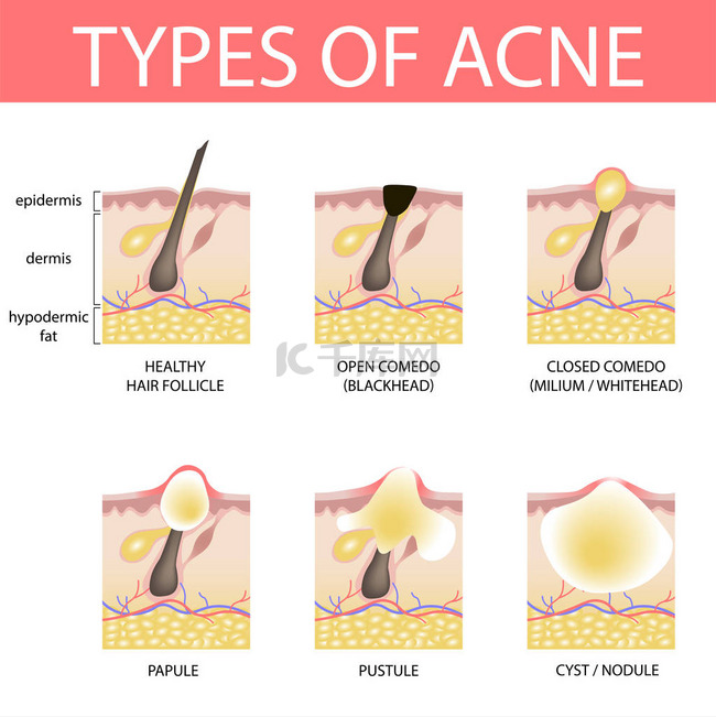 人类不同类型痤疮的医学病媒插图