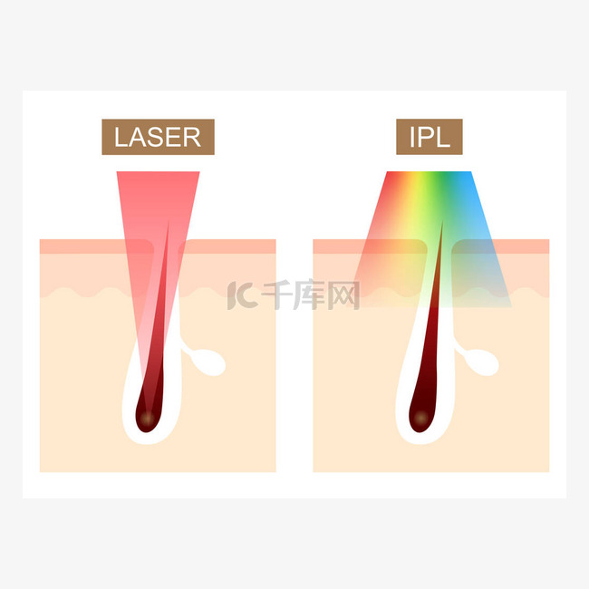 激光和IPL (强脉冲光)脱毛