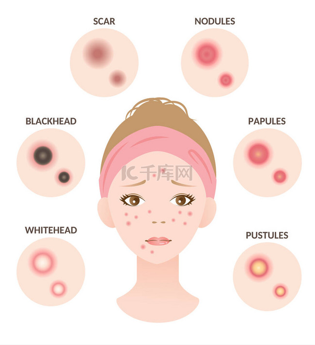 粉刺的类型和女性面部的图解。白
