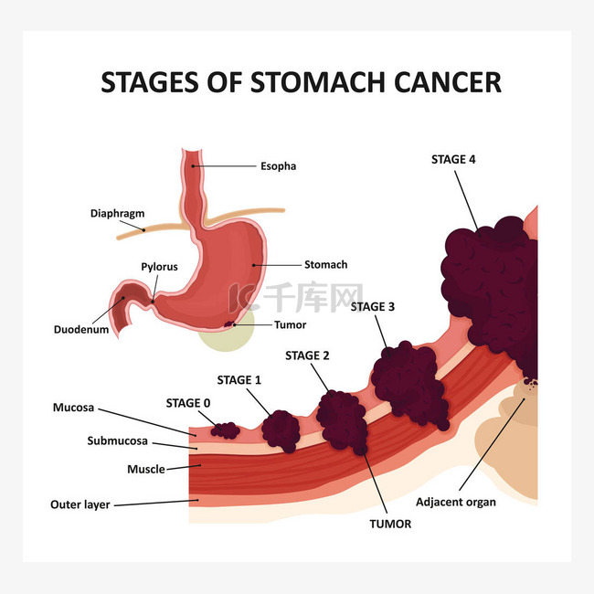 胃癌的阶段。恶性肿瘤的分类.