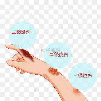 手臂烧伤烫伤分级