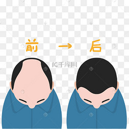 植发前后对比
