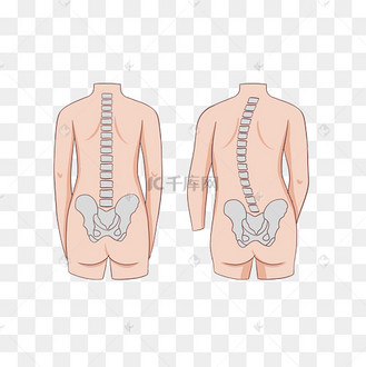 脊柱侧弯矫正