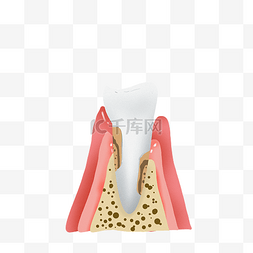 口腔牙齿牙周炎