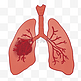 肺气肿肺结核肺癌