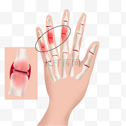 关节痛骨骼图片_手指关节炎发炎肿痛
