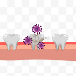 宫颈癌炎症图片_牙齿牙周炎