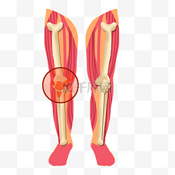 关节炎图片_膝关节疼痛