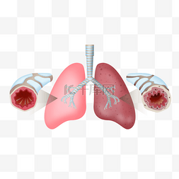 肺部疾病图片_世界慢阻肺日慢阻肺