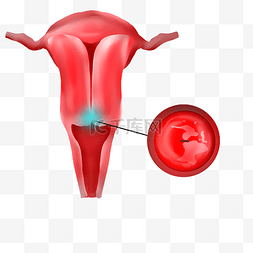 宫颈癌是图片_身体器官子宫疾病