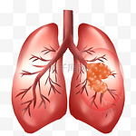 肺器官恶性肿瘤