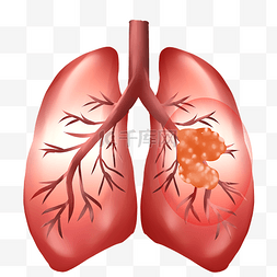 肺器官恶性肿瘤