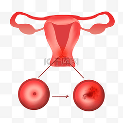 宫颈癌炎症图片_宫颈癌子宫