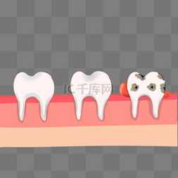 牙龈出血图片_牙齿牙周炎