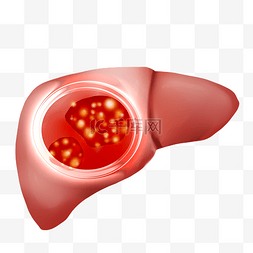 病毒性肝炎图片_肝癌癌症