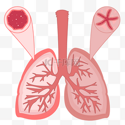 肺部素材图片_慢阻肺对比肺部图