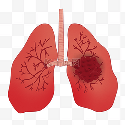 肺气肿图片_肺癌肺部疾病