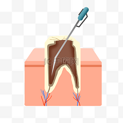 根管治疗图片_口腔科根管治疗