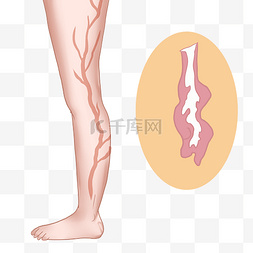 颈动脉硬化示意图图片_腿部静脉曲张