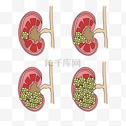 人体图图片_人体器官肾脏肾癌