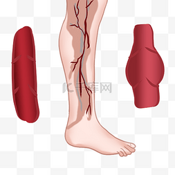 腿部图片_腿部静脉曲张肿胀疼痛