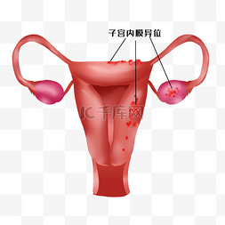 子宫内膜异位图片_子宫妇科病子宫内膜异位症