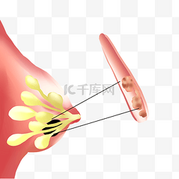 乳腺炎肿瘤