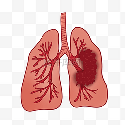 肺部疾病图片_肺癌支气管肺炎